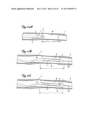 MATERIAL REMOVAL DEVICE AND METHOD OF USE diagram and image