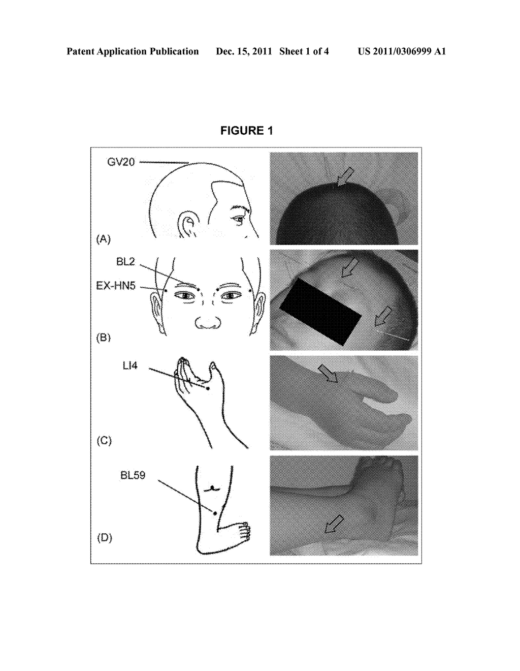 STIMULATION OF SPECIFIC ACUPUNCTURE POINTS FOR VISION IMPROVEMENT - diagram, schematic, and image 02