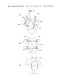 SYSTEMS AND METHODS FOR STABILIZATION OF BONE STRUCTURES diagram and image