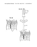 ADAPTIVE SPINAL ROD AND METHODS FOR STABILIZATION OF THE SPINE diagram and image