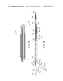 STENT ALIGNMENT DURING TREATMENT OF A BIFURCATION diagram and image