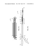 STENT ALIGNMENT DURING TREATMENT OF A BIFURCATION diagram and image