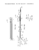 STENT ALIGNMENT DURING TREATMENT OF A BIFURCATION diagram and image