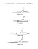 STENT ALIGNMENT DURING TREATMENT OF A BIFURCATION diagram and image