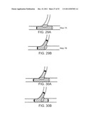 STENT ALIGNMENT DURING TREATMENT OF A BIFURCATION diagram and image