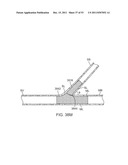 STENT ALIGNMENT DURING TREATMENT OF A BIFURCATION diagram and image