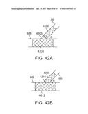 STENT ALIGNMENT DURING TREATMENT OF A BIFURCATION diagram and image