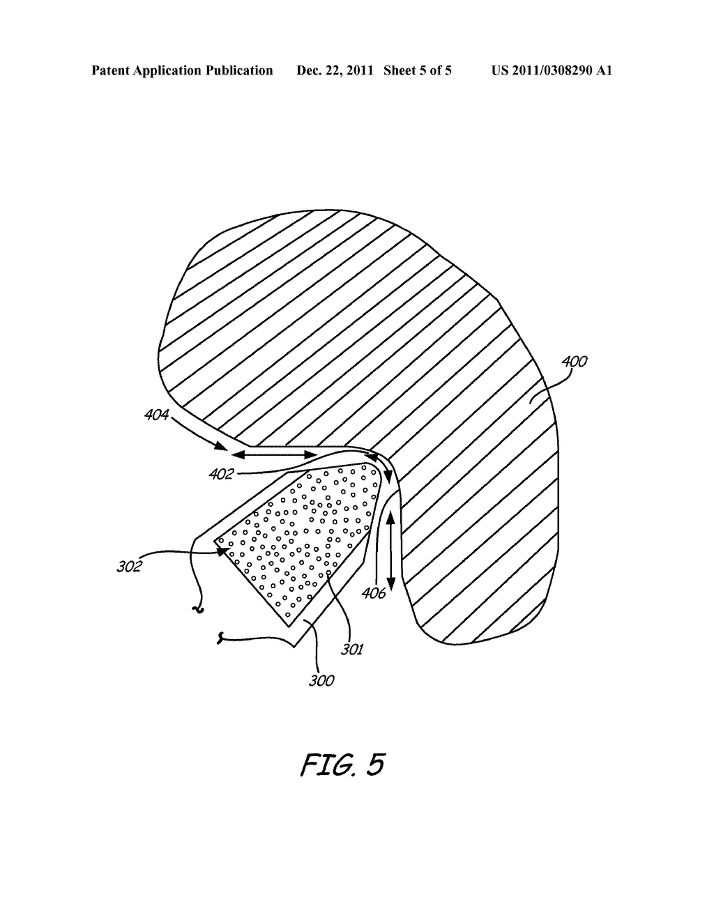 METHOD FOR ULTRASONIC PEENING OF GAS TURBINE ENGINE COMPONENTS WITHOUT     ENGINE DISASSEMBLY - diagram, schematic, and image 06