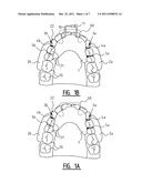 Apparatus for Clamping on the Lower or Upper Teeth, and Activator     Comprising Such an Apparatus diagram and image