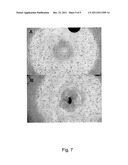 TREATMENT OF OCULAR DISEASES diagram and image