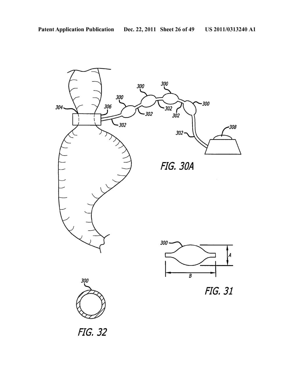 FLOW RESTRICTOR AND METHOD FOR AUTOMATICALLY CONTROLLING PRESSURE FOR A     GASTRIC BAND - diagram, schematic, and image 27
