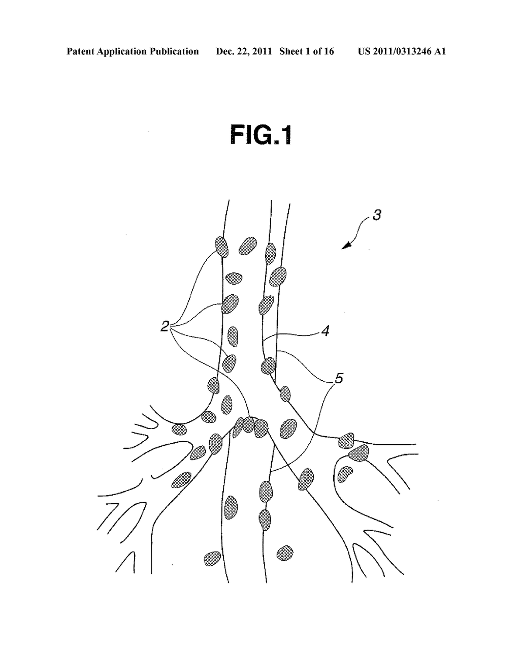 TREATMENT INSTRUMENT FOR ENDOSCOPE AND METHOD OF HARVESTING LYMPH NODE - diagram, schematic, and image 02