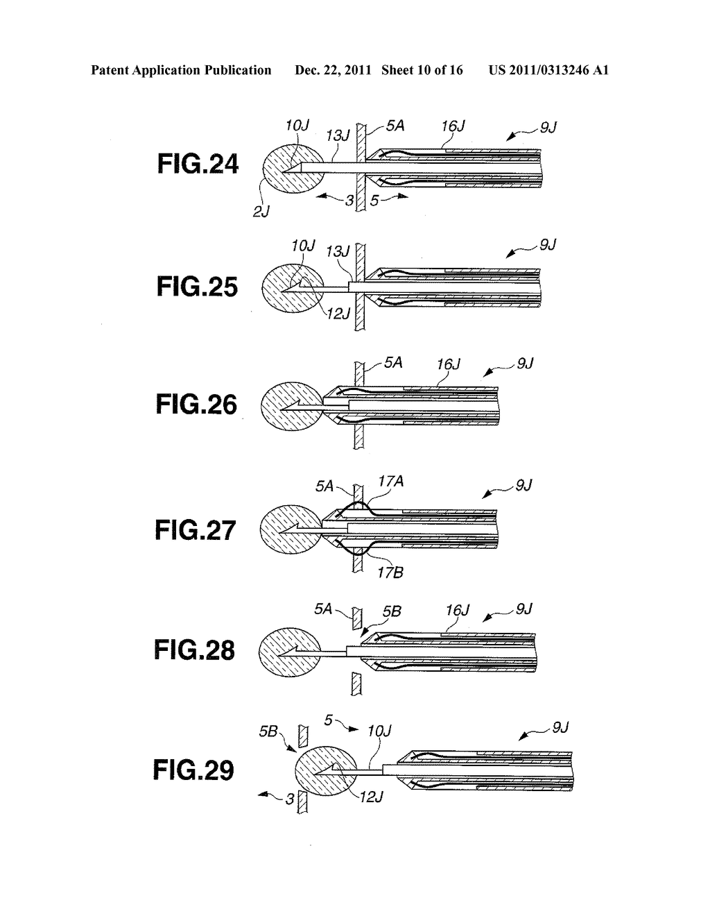 TREATMENT INSTRUMENT FOR ENDOSCOPE AND METHOD OF HARVESTING LYMPH NODE - diagram, schematic, and image 11