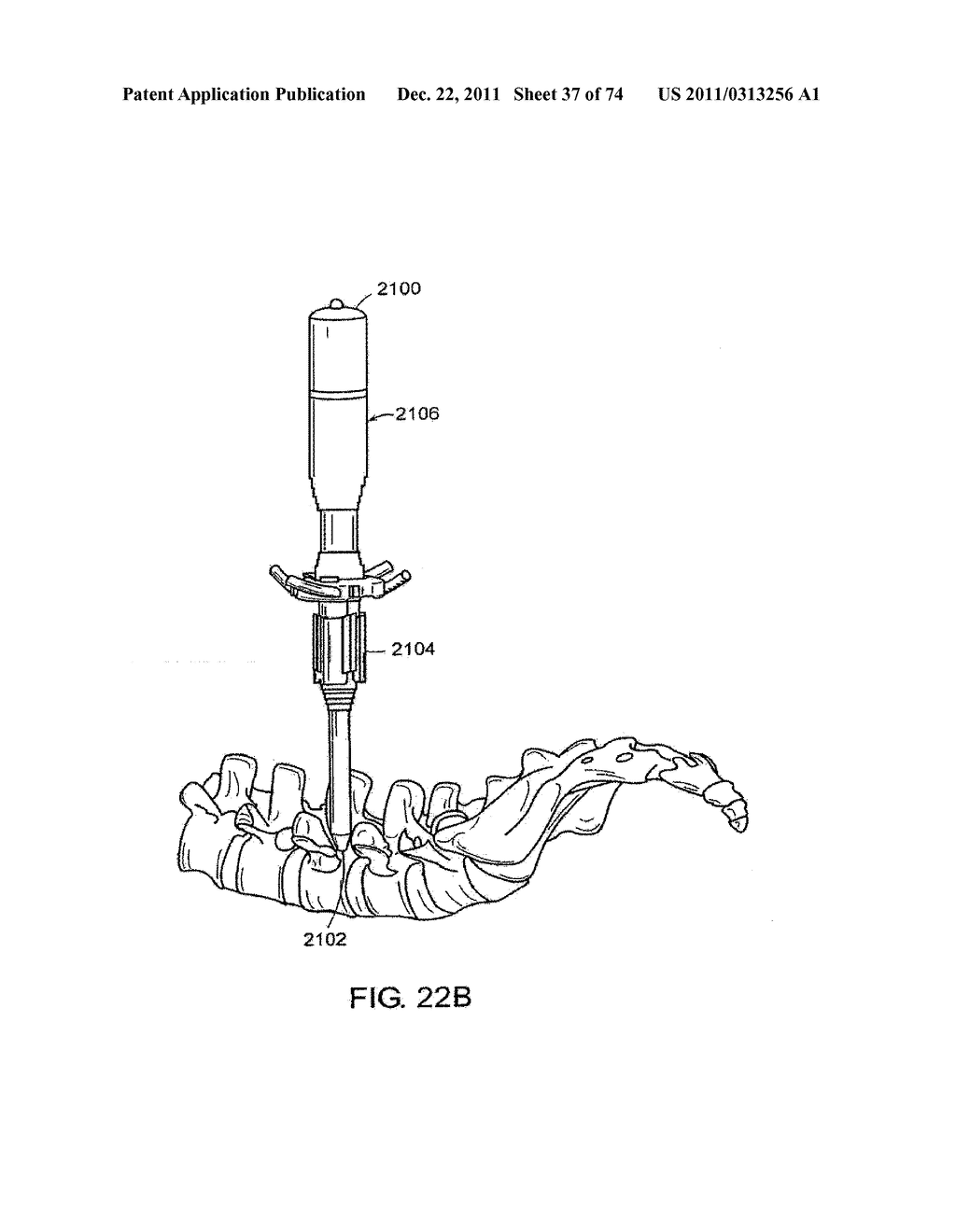 SURGICAL METHODS AND SURGICAL KITS - diagram, schematic, and image 38