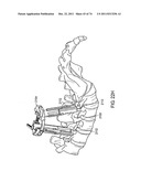 SURGICAL METHODS AND SURGICAL KITS diagram and image