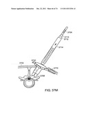 SURGICAL METHODS AND SURGICAL KITS diagram and image