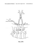 SURGICAL METHODS AND SURGICAL KITS diagram and image