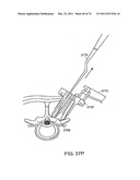 SURGICAL METHODS AND SURGICAL KITS diagram and image