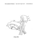 SURGICAL METHODS AND SURGICAL KITS diagram and image