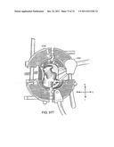 SURGICAL METHODS AND SURGICAL KITS diagram and image