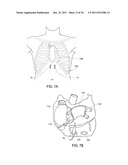 SUBXYPHOID EPICARDIAL ABLATION diagram and image