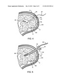 Methods and apparatus for dissolving blockages in intracranial catheters diagram and image