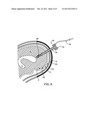 Methods and apparatus for dissolving blockages in intracranial catheters diagram and image