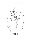 Methods and apparatus for dissolving blockages in intracranial catheters diagram and image