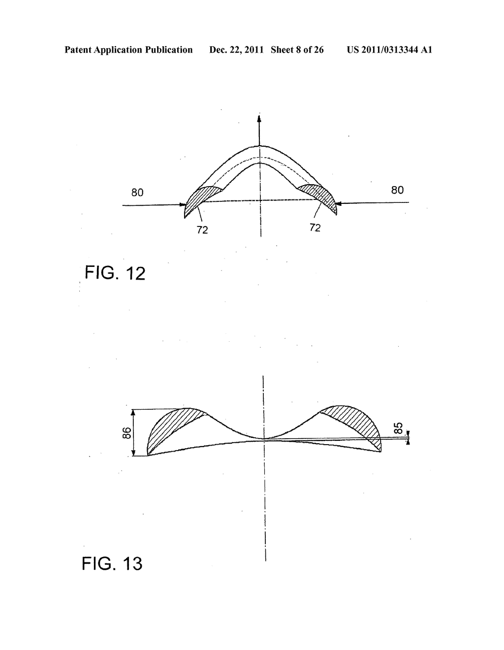 Method for treating refractive errors and vision disorders of an eye - diagram, schematic, and image 09