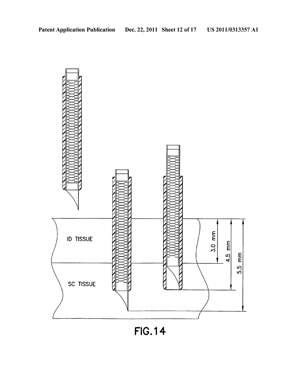 INFUSION SET AND/OR PATCH PUMP HAVING AT LEAST ONE OF AN IN-DWELLING RIGID     CATHETER WITH FLEXIBLE FEATURES AND/OR A FLEXIBLE CATHETER ATTACHMENT - diagram, schematic, and image 13