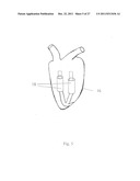 IN VIVO DEVICE FOR IMPROVING DIASTOLIC VENTRICULAR FUNCTION diagram and image