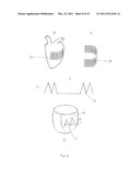 IN VIVO DEVICE FOR IMPROVING DIASTOLIC VENTRICULAR FUNCTION diagram and image