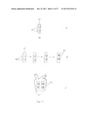 IN VIVO DEVICE FOR IMPROVING DIASTOLIC VENTRICULAR FUNCTION diagram and image