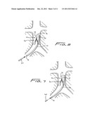 Method Of Removing A Vein Filter diagram and image