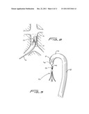 Method Of Removing A Vein Filter diagram and image