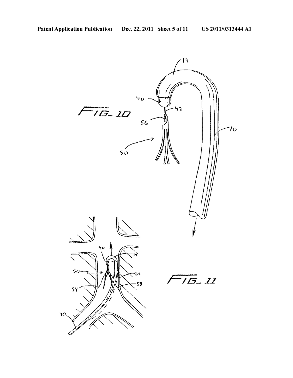 Method Of Removing A Vein Filter - diagram, schematic, and image 06