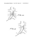 Method Of Removing A Vein Filter diagram and image