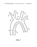 EMBOLIC PROTECTION DURING PERCUTANEOUS HEART VALVE REPLACEMENT AND SIMILAR     PROCEDURES diagram and image