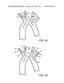 EMBOLIC PROTECTION DURING PERCUTANEOUS HEART VALVE REPLACEMENT AND SIMILAR     PROCEDURES diagram and image