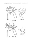 EMBOLIC PROTECTION DURING PERCUTANEOUS HEART VALVE REPLACEMENT AND SIMILAR     PROCEDURES diagram and image