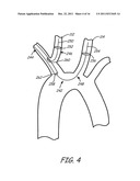 EMBOLIC PROTECTION DURING PERCUTANEOUS HEART VALVE REPLACEMENT AND SIMILAR     PROCEDURES diagram and image