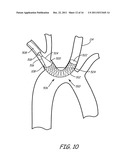 EMBOLIC PROTECTION DURING PERCUTANEOUS HEART VALVE REPLACEMENT AND SIMILAR     PROCEDURES diagram and image