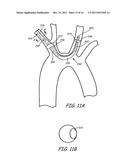 EMBOLIC PROTECTION DURING PERCUTANEOUS HEART VALVE REPLACEMENT AND SIMILAR     PROCEDURES diagram and image