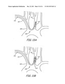 EMBOLIC PROTECTION DURING PERCUTANEOUS HEART VALVE REPLACEMENT AND SIMILAR     PROCEDURES diagram and image