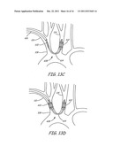 EMBOLIC PROTECTION DURING PERCUTANEOUS HEART VALVE REPLACEMENT AND SIMILAR     PROCEDURES diagram and image