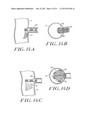 Cardiac Valve Procedure Methods and Devices diagram and image