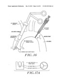 Cardiac Valve Procedure Methods and Devices diagram and image