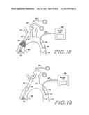 Cardiac Valve Procedure Methods and Devices diagram and image