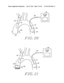 Cardiac Valve Procedure Methods and Devices diagram and image