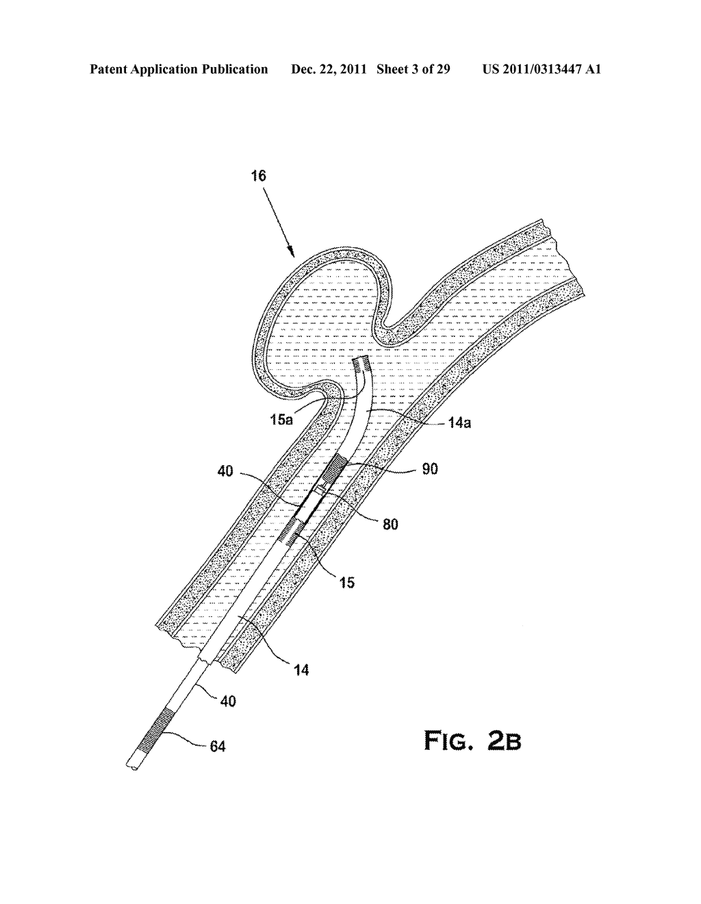 SYSTEM AND METHOD FOR MECHANICALLY POSITIONING INTRAVASCULAR IMPLANTS - diagram, schematic, and image 04